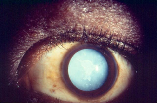 Mature Cataract Mature Cataract
