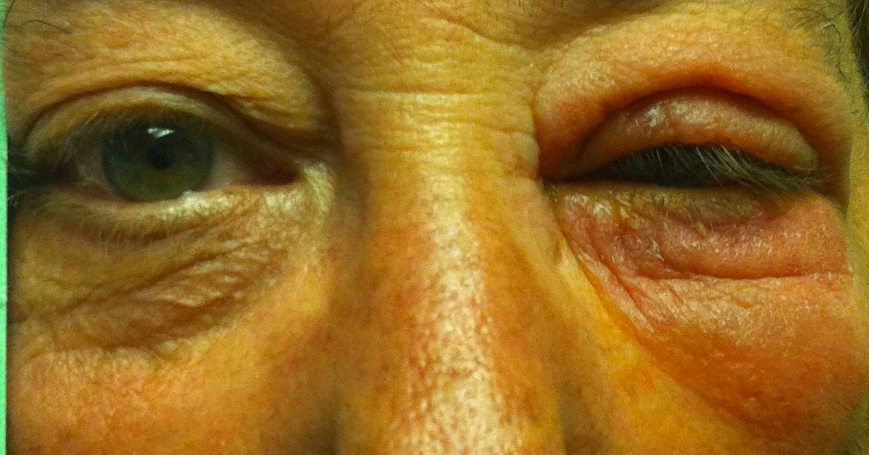 Allergic Blepharoconjunctivitis Allergic Blepharoconjunctivitis
