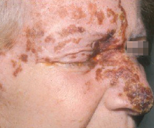Herpes Zoster Ophthalmicus